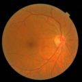 What is Diabetic Eye Disease? thumbnail image