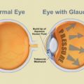 Support group for people with Glaucoma thumbnail image